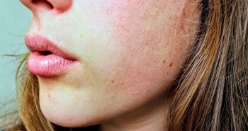 Những lầm tưởng về bệnh eczema