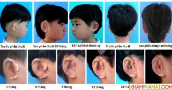 Trung Quốc nuôi và cấy ghép thành công tai từ tế bào sụn