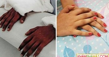 Lần đầu thế giới, bác sĩ Việt ghép tay của người sống cho bệnh nhân