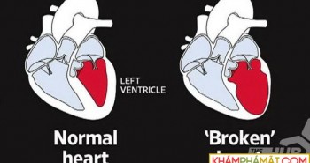 Hội chứng trái tim tan vỡ là do đâu?