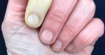 Ngón tay trắng bệch cảnh báo bệnh nguy hiểm