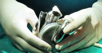 Úc phát triển thiết bị cấy ghép tim đột phá, mở ra hy vọng mới cho bệnh nhân suy tim