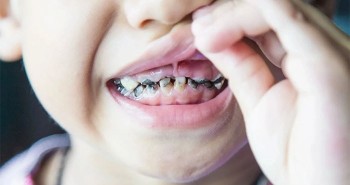 Vì sao trẻ con luôn bị sâu răng?