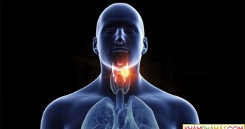 Phân biệt ung thư vòm họng và viêm họng thông thường